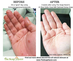Side-by-side comparison showing inflamed eczema skin before and clear, calm skin after using The Soap Haven Oatmeal Honey Goat Milk Soap